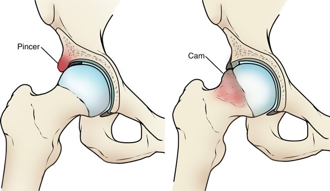 hip pain squatting image