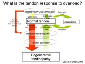 tendinopathy diagram