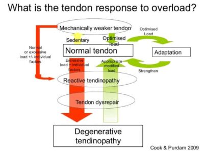 Treating Achilles Tendinopathy with Barbell Rehab