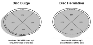 disc bulge vs. disc herniation