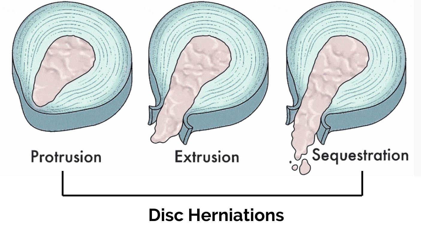 types of herniated discs