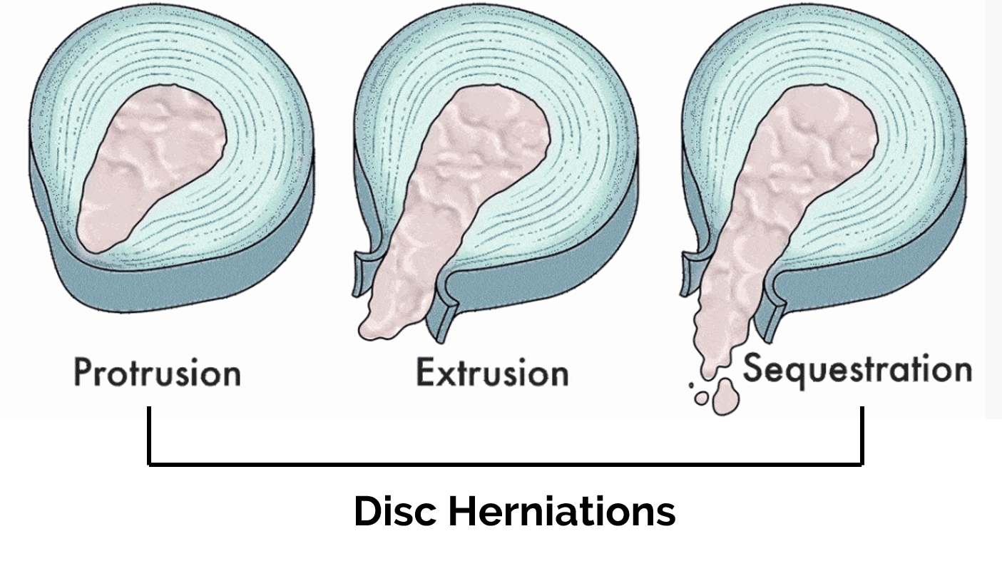 Types Of Herniated Discs Barbell Rehab