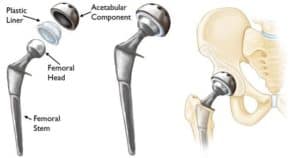 hip replacement diagram